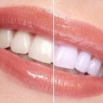 teeth whitening near me