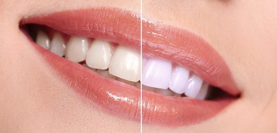 teeth whitening near me