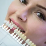 composite veneers near me