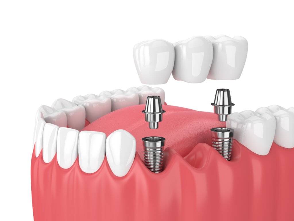 teeth implants
