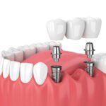 teeth implants